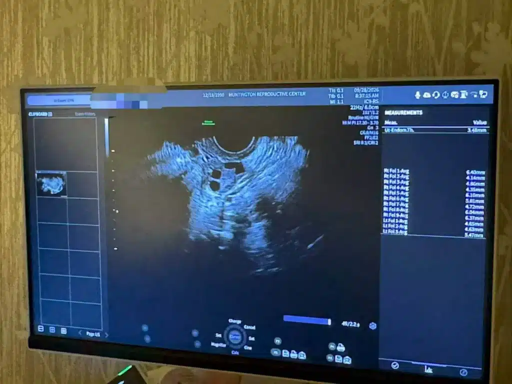 Ultrasound monitor showing ovarian follicle scan at the fertility center