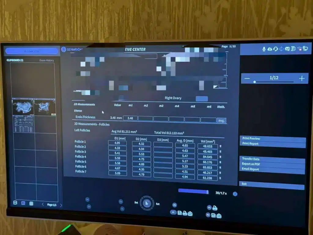 Ultrasound follicle measurement screen showing sized follicles