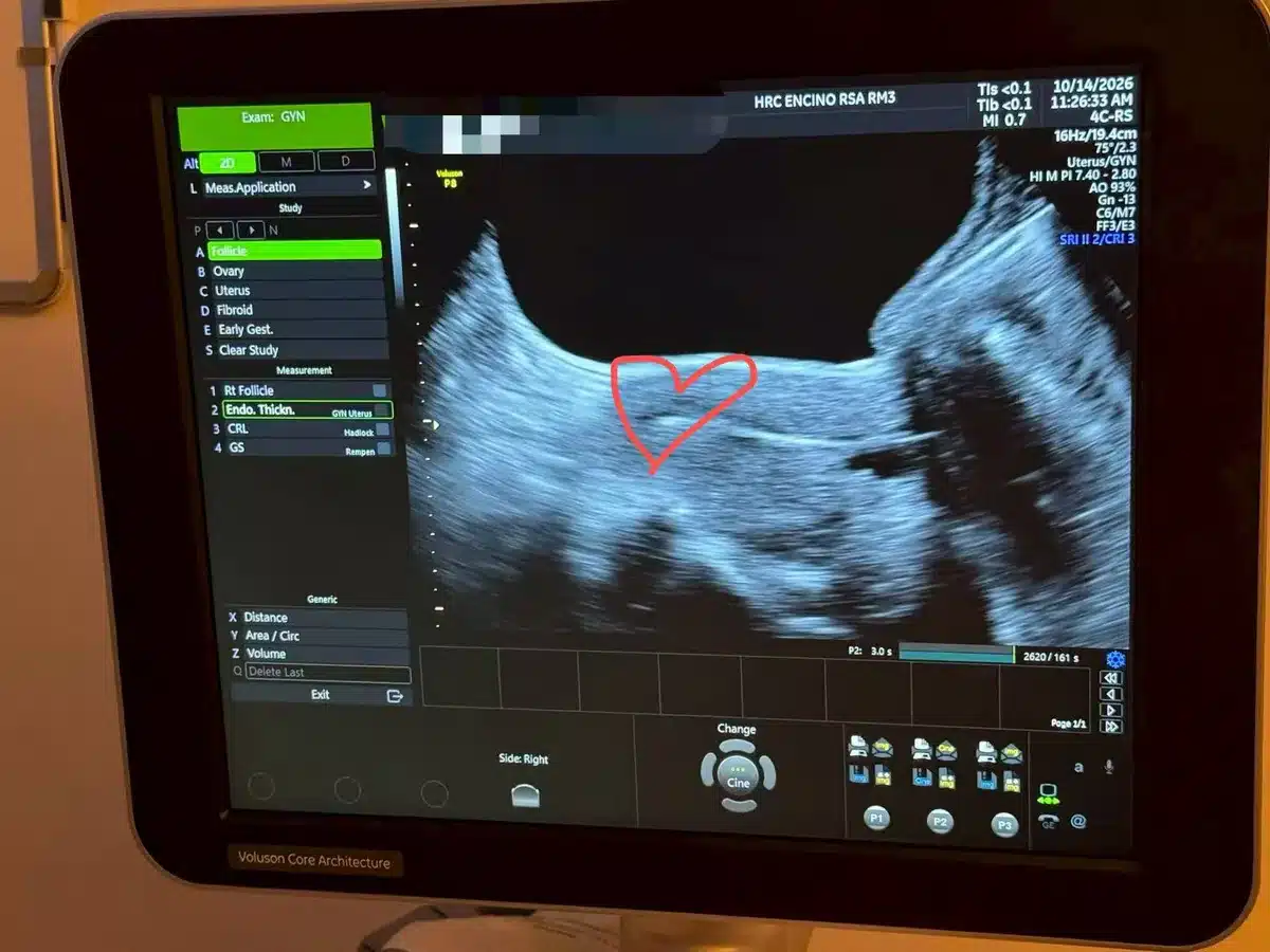 Ultrasound scan showing a healthy early pregnancy
